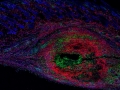 Fibroblastic-vortex